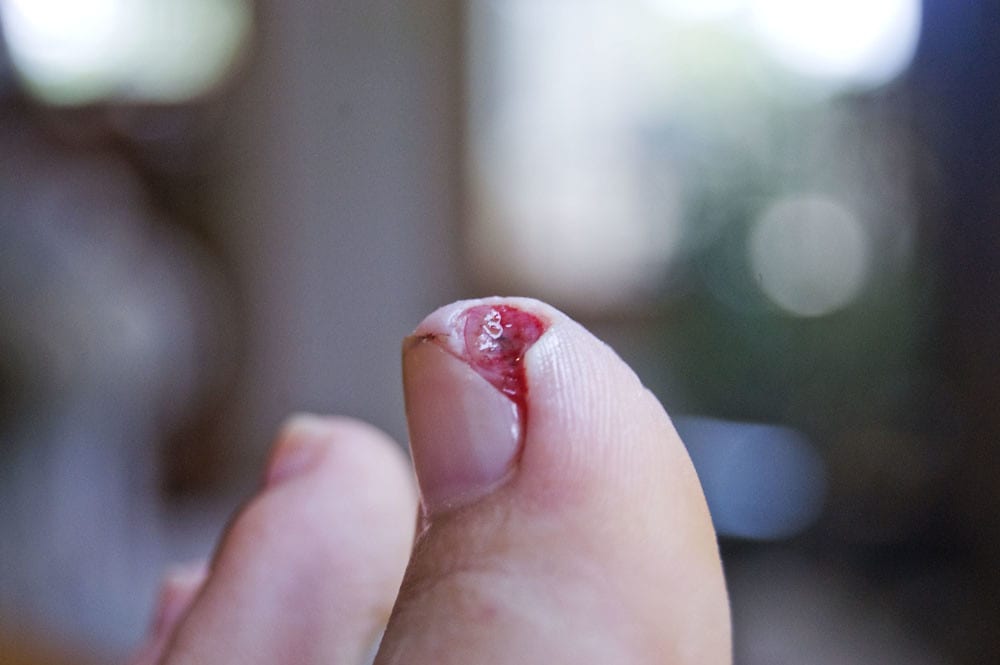 Dos and Donts for Handling Ingrown Toenails