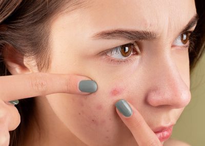 How To Care For Acne