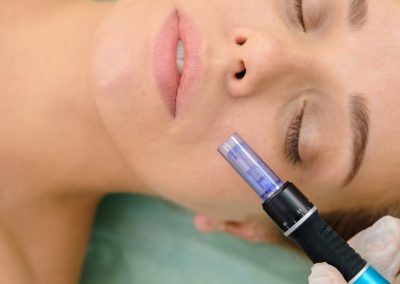 A Guide To Microneedling: The Best For Beginners
