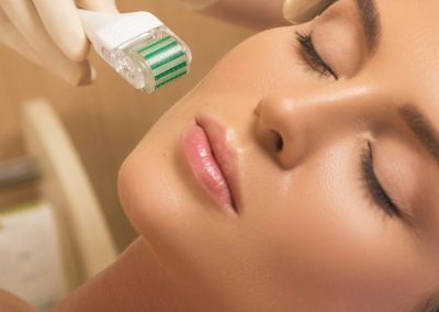 A Comprehensive Guide To Microneedling For Acne Scars