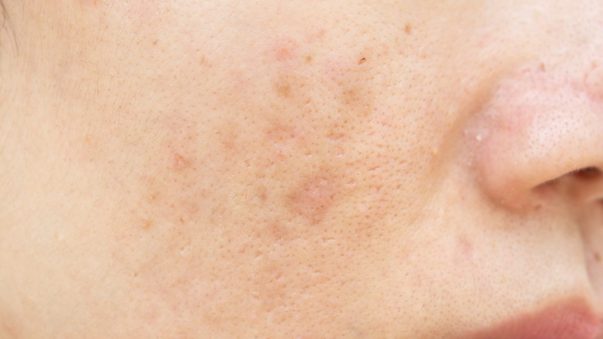 microneedling for large pores