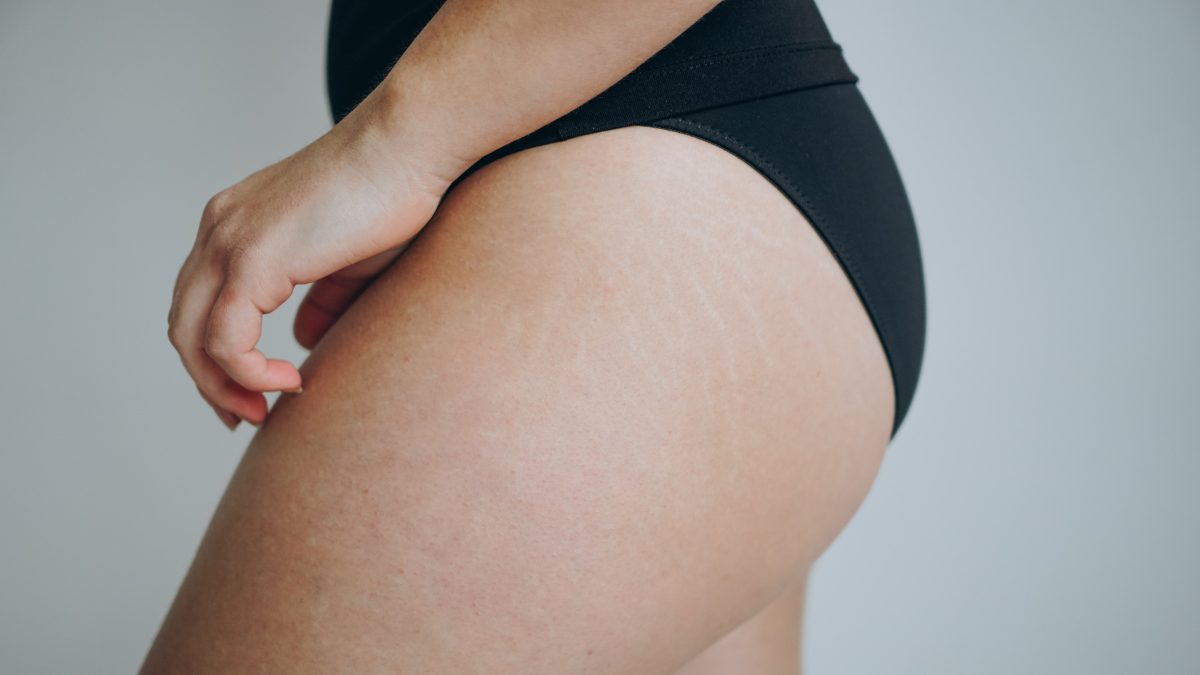 microneedling for stretch marks
