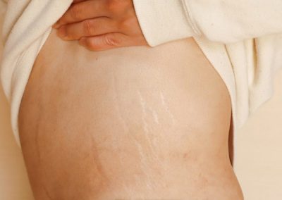 The Best Guide To Microneedling For Stretch Marks