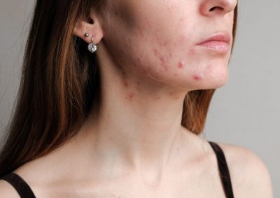 The Best Basic Guide To Acne-Prone Skin