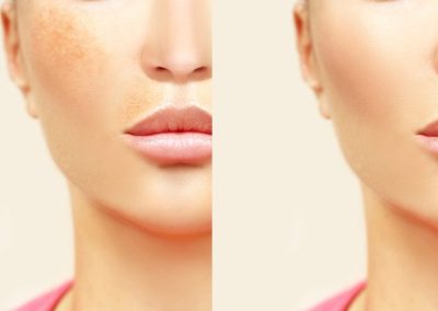 How To Treat Melasma From The Inside: 15 Amazing Tips