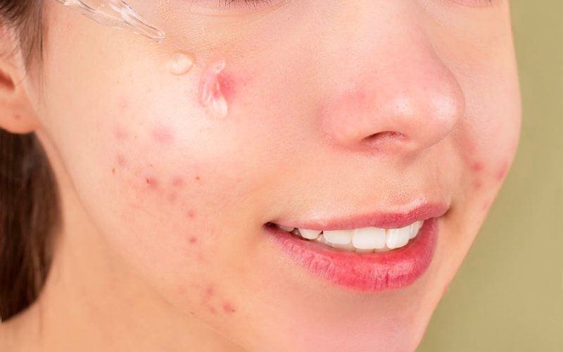 skincare ingredient for acne