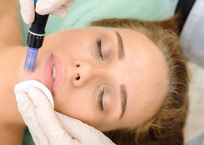 How To Prepare For Microneedling: Top 10 Tips